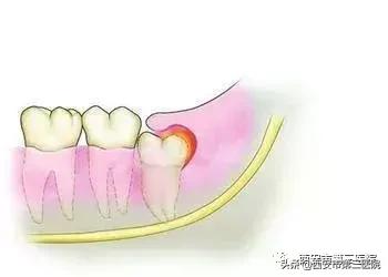 拔智齿不长平咋办,拔第二磨牙不拔智齿可以吗
