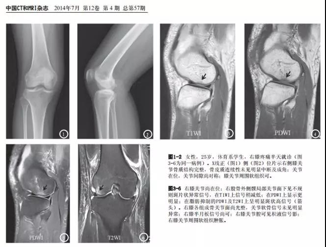 运动膝盖疼痛怎么办戴什么护膝,膝关节韧带损伤钻心的疼
