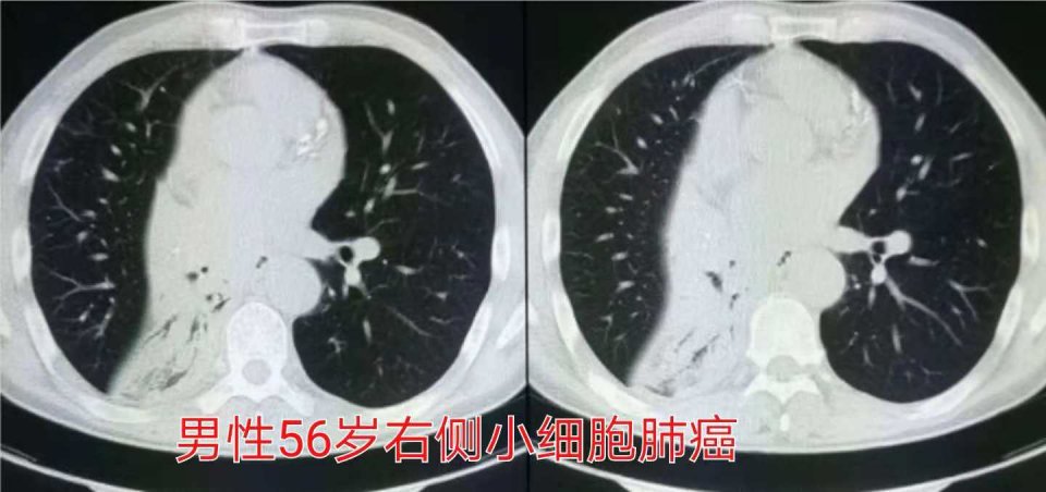 与肺癌病人一起生活需要注意什么,与肺癌抗战的第七个月