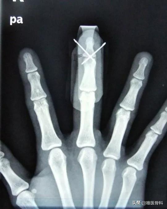 骨折打了钢筋了要取出来吗,骨折打了钢板能定残吗