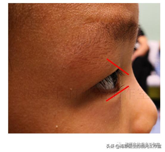 孩子不愿意测眼压怎么办,小朋友有必要测眼压吗有必要查吗