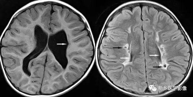 影像学脑室扩大,脑室显大怎么理解