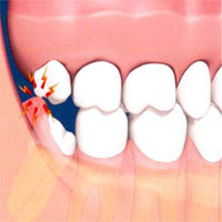 吃饭咬到腮帮怎么好得快,吃东西咬到腮帮是上火吗