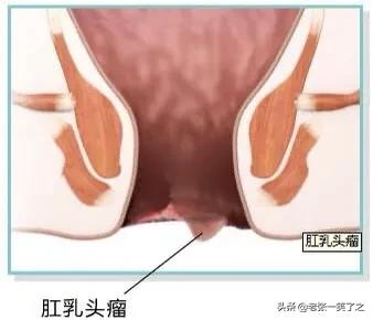 肛乳头“瘤”是不是一定要立刻手术？