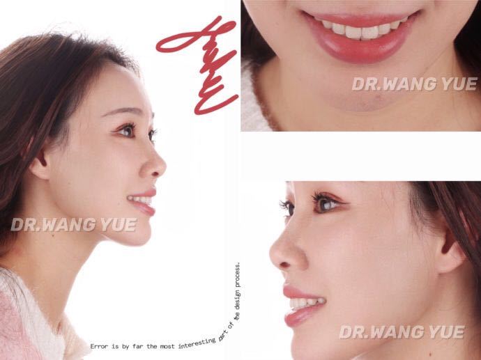 牙齿美学修复的缺点,大龄牙齿矫正经历和感受