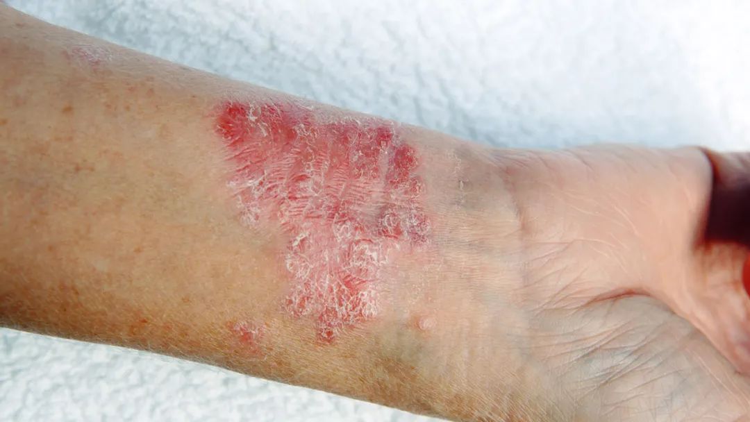 一到冬天就全身瘙痒,一到冬天全身皮肤瘙痒是什么原因