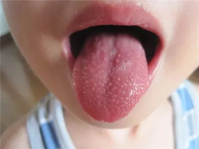 一招教你看舌苔图片,一张图看懂孩子学习