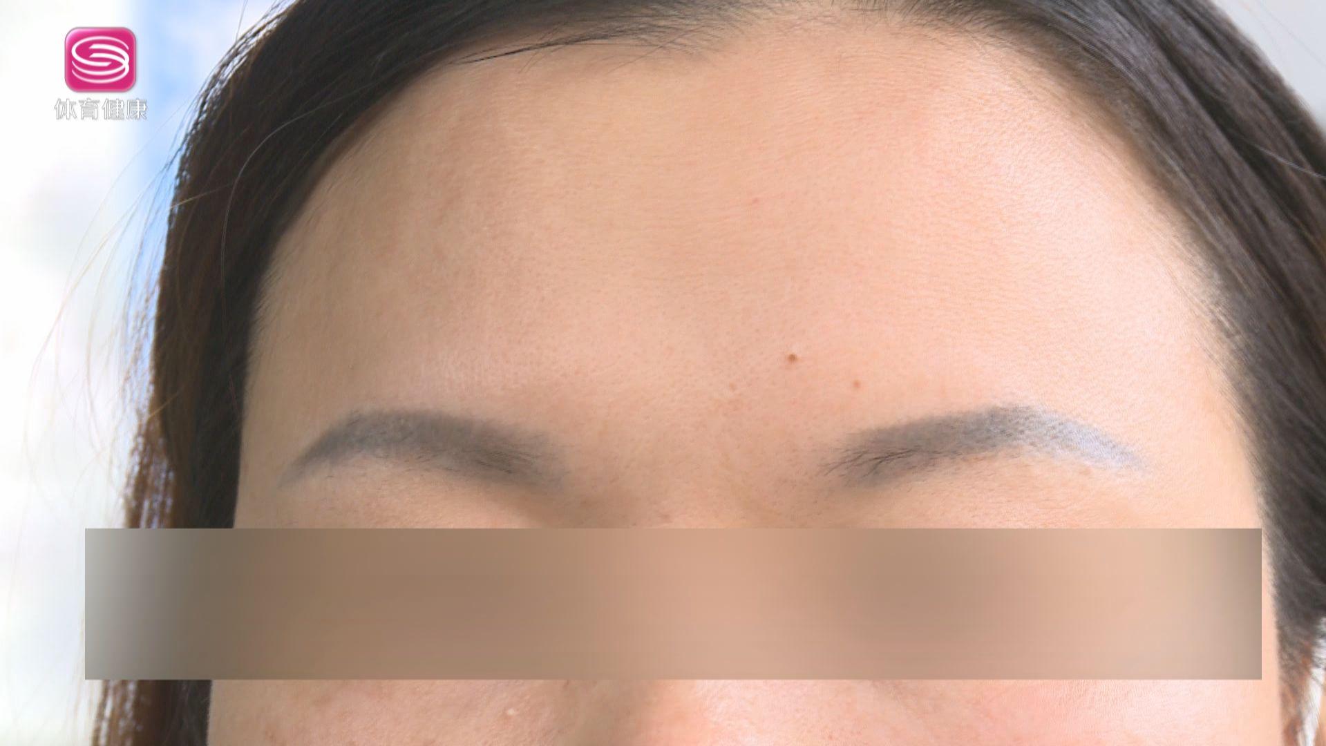 改善法令纹需要做小拉皮吗,原来淡化法令纹这么简单