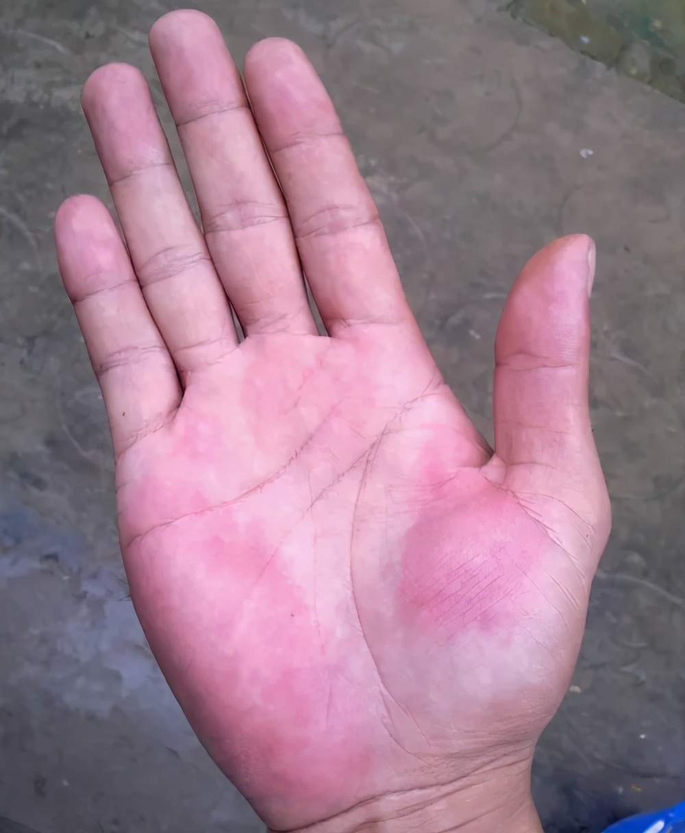 身上长了红色的蜘蛛点怎么回事,身上有蜘蛛红点