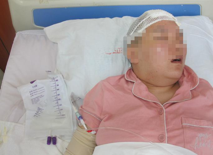 脑室有粘连脑积水有什么办法,脑动脉畸形手术后出现急性脑积水