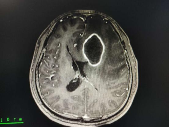 挤痘一时爽,挤完脑脓肿?|健康问答133期