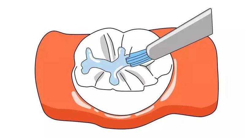 有蛀牙的孩子有必要做窝沟封闭吗,窝沟封闭能防蛀牙