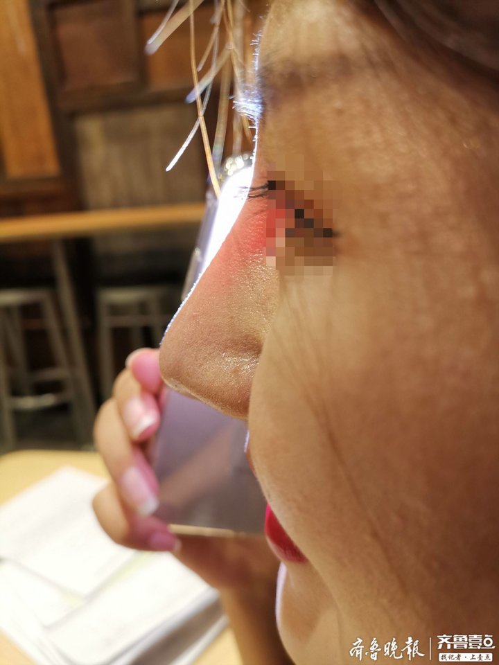 整形手术隆鼻女,济南整形女后续