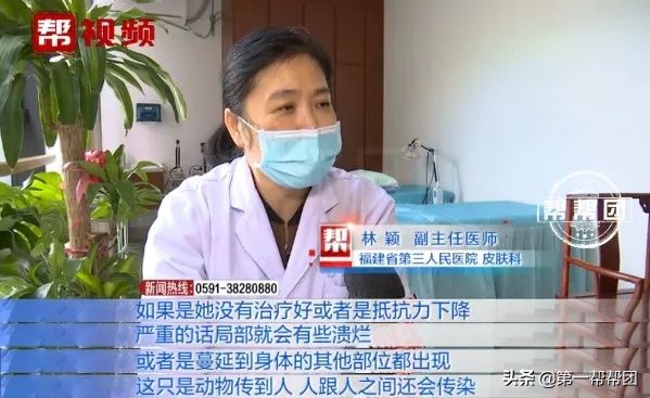 人传染上猫癣身上痒,七岁女孩染上猫癣