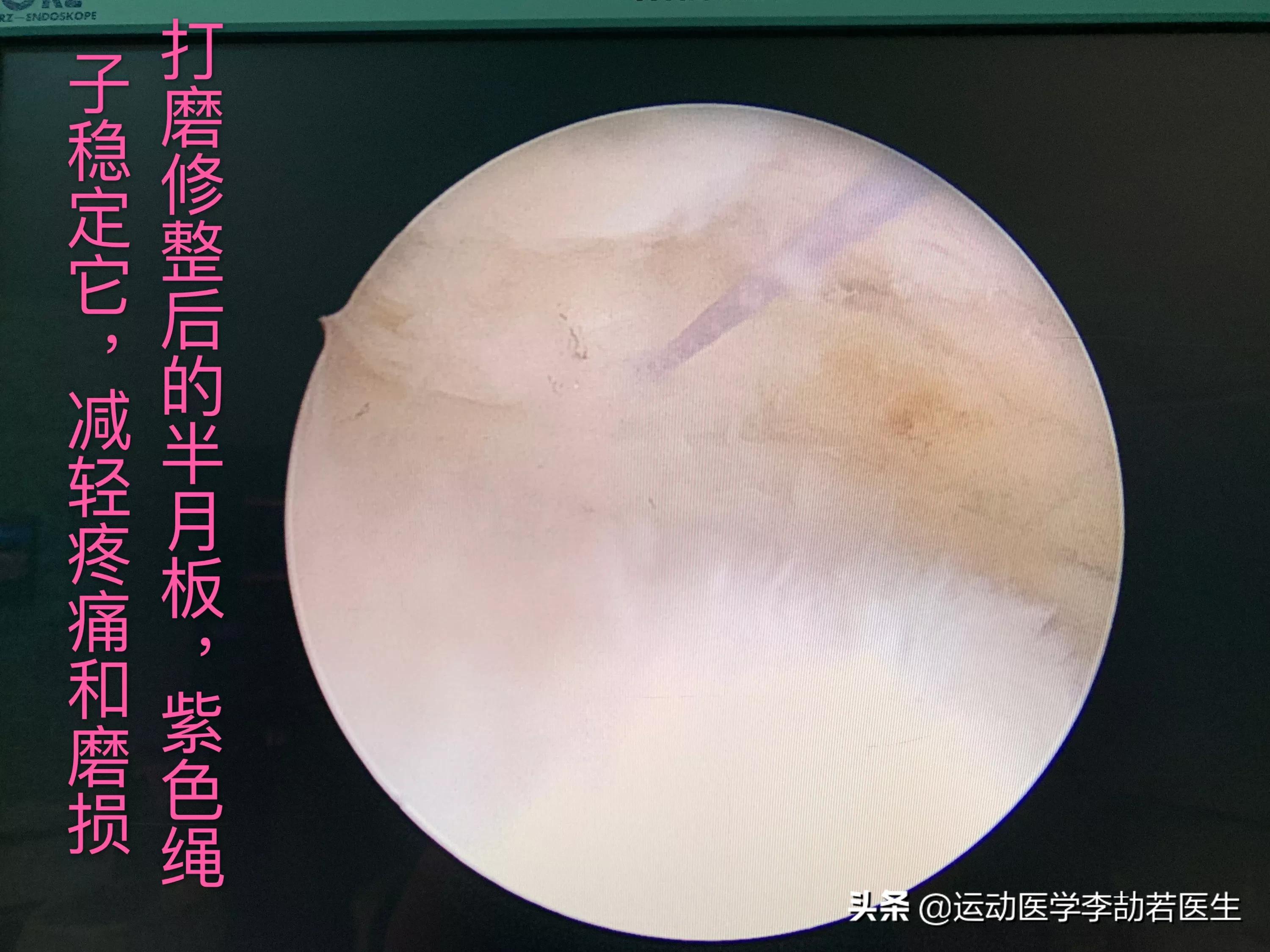 骨关节炎到底该怎么治,骨关节炎怎么治才能彻底治好