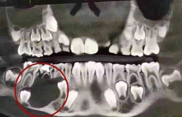 宝宝牙齿有黑色素沉着,宝宝牙齿有像烟渍一样的东西