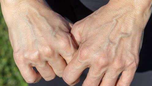 手背青筋明显是血管硬化的表现吗,血管有问题看哪个科