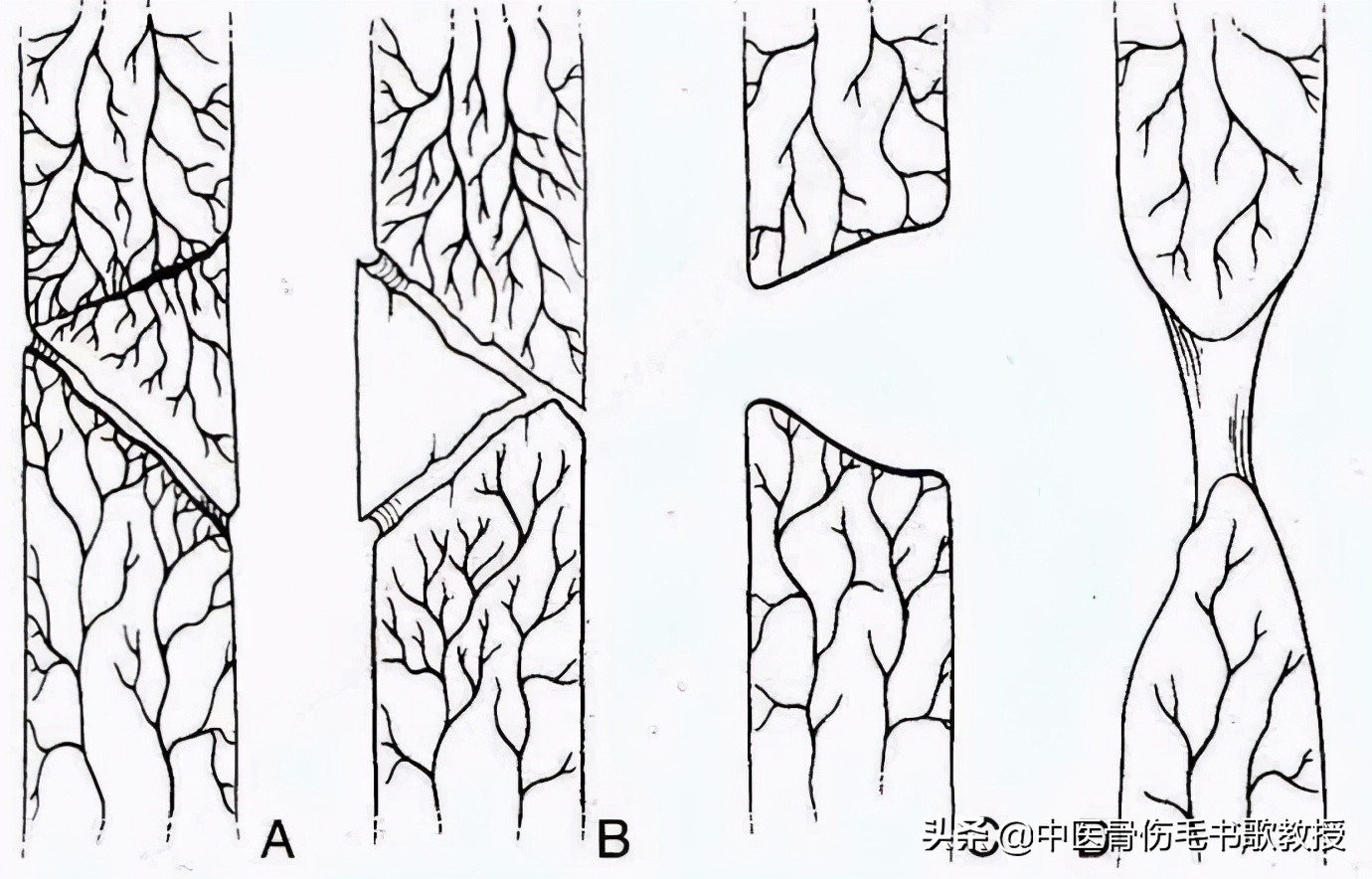 骨折延迟愈合与骨折不愈合的区别,骨折愈合后多久做伤情鉴定