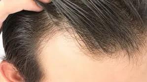 米诺地尔脱发女士专用,米诺地尔对于m型脱发非常有效果