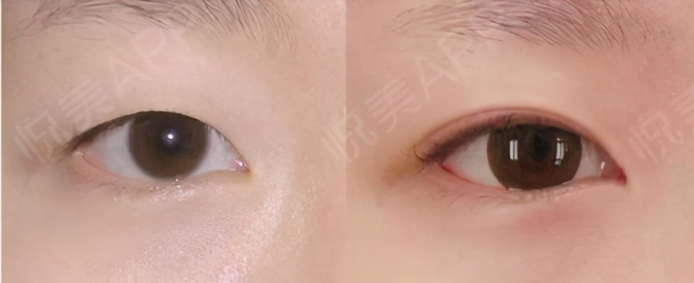 怎么判断自己适合什么双眼皮类型,如何了解自己适合哪种双眼皮类型