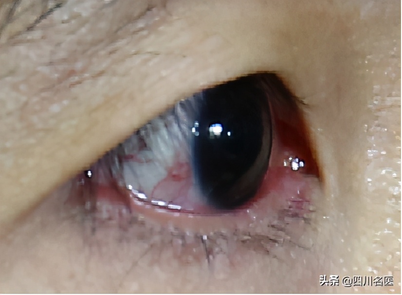 一把年纪了还总长痘,一把年纪了脸上还爆痘