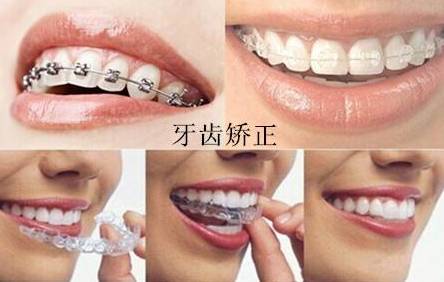牙齿矫正照片拍摄视频,一分钟揭秘什么是牙齿矫正
