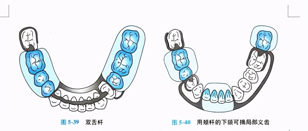 牙列缺损的可摘局部义齿修复题库,牙科美学修复精讲