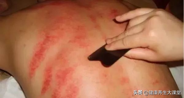 刮痧后出的痧怎样消退得快,刮痧后表现出来的痧有哪几种