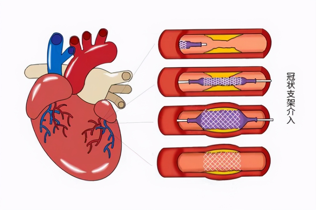 好消息心脑血管病的新疗法,合肥心脏支架最好医院