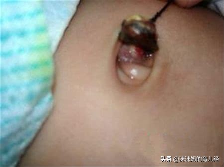 新生儿脐带一个月不掉感觉有点长,新生儿脐带你必须知道的常识