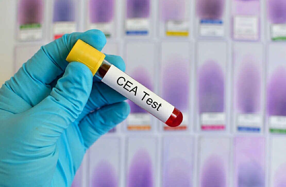 癌胚抗原升高就是癌症吗,癌胚抗原升高是真的吗
