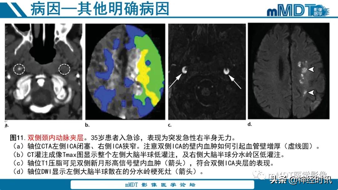 急性缺血性脑卒中ppt素材图片,青年缺血性脑卒中ppt