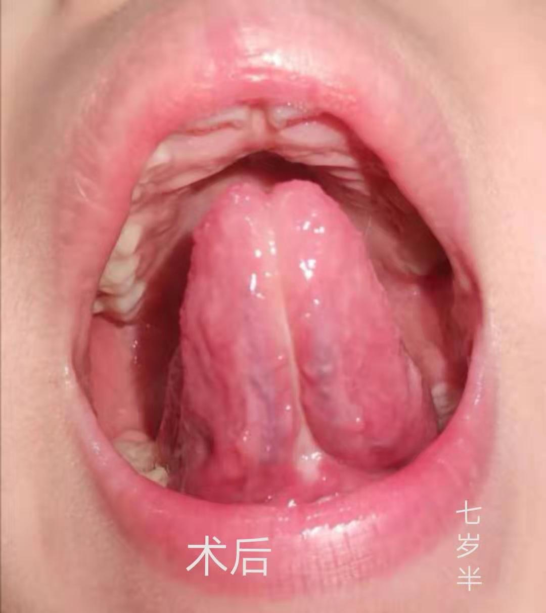 剪舌系带的全过程有危险吗,孩子舌系带矫正术