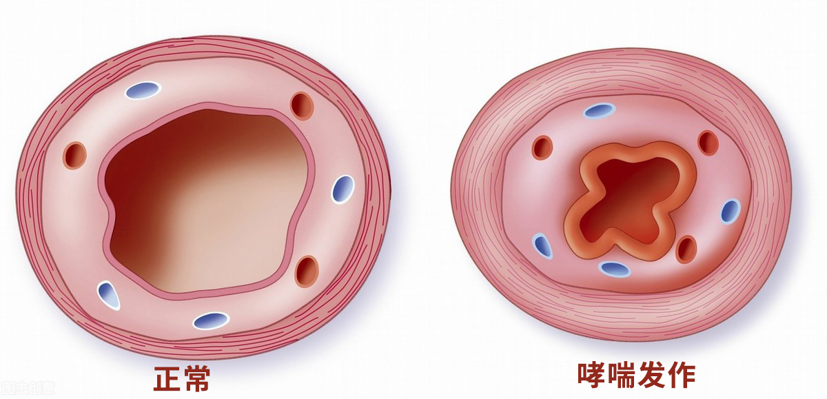 哮喘未来有可能攻克吗,哮喘未来30年有望治愈的疾病