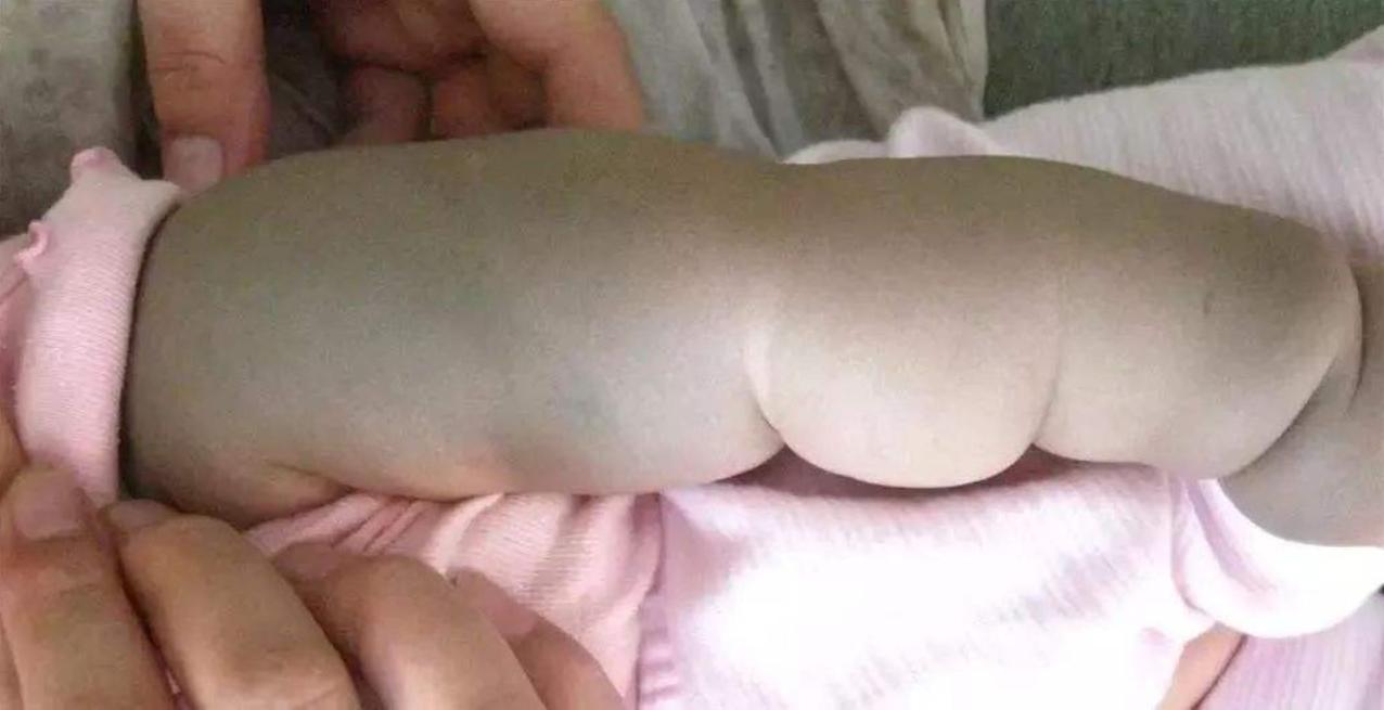 婴儿身上像有淤青一样的怎么回事,小婴儿身上有淤青是什么原因