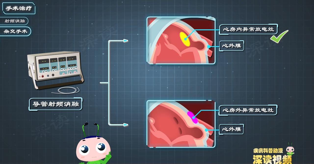 房颤射频消融术与心脏搭桥与支架,房颤选择迷宫术还是射频消融术