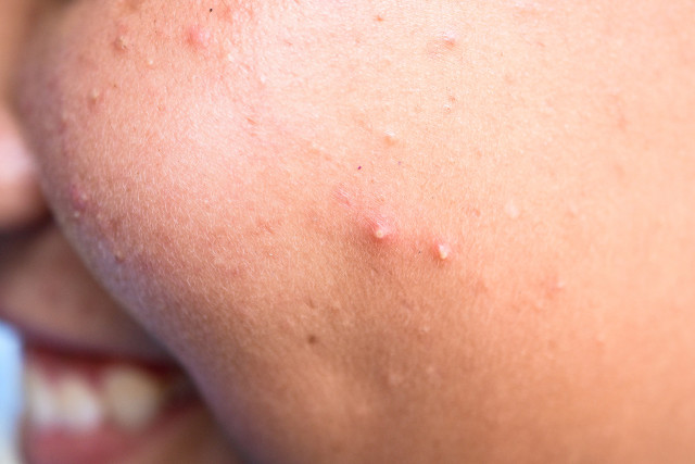 白色有脓的痘痘怎么处理,火疖子白色脓头能挤吗