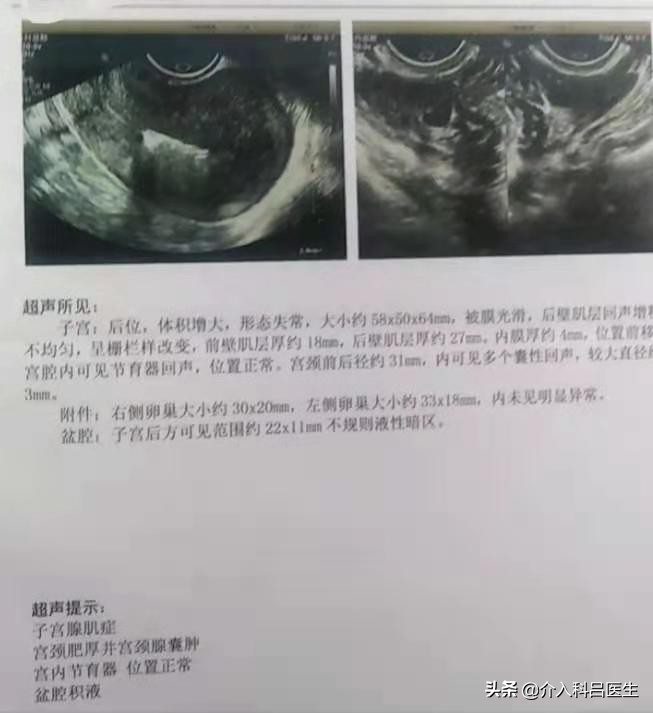 备孕女子有子宫腺肌症,大龄患子宫腺肌症还能生育吗