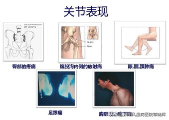 类风湿性关节炎能彻底治愈吗,类风湿性关节炎怎样才能真正治愈