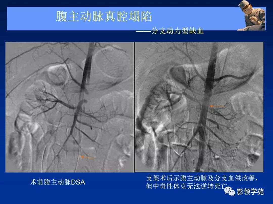 主动脉夹层壁间血肿如何鉴别,主动脉夹层血肿溃疡
