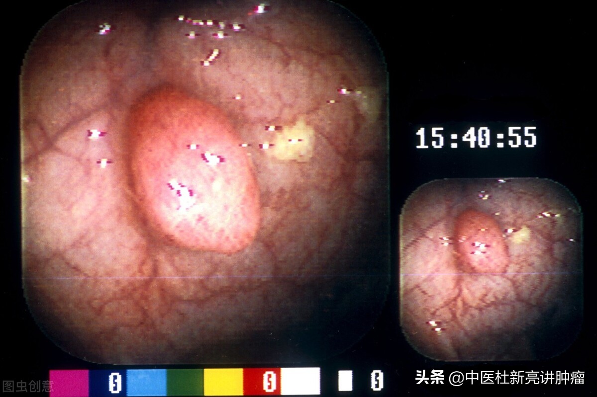 胃息肉切除创面怎么止血,胃息肉手术后怎么调养