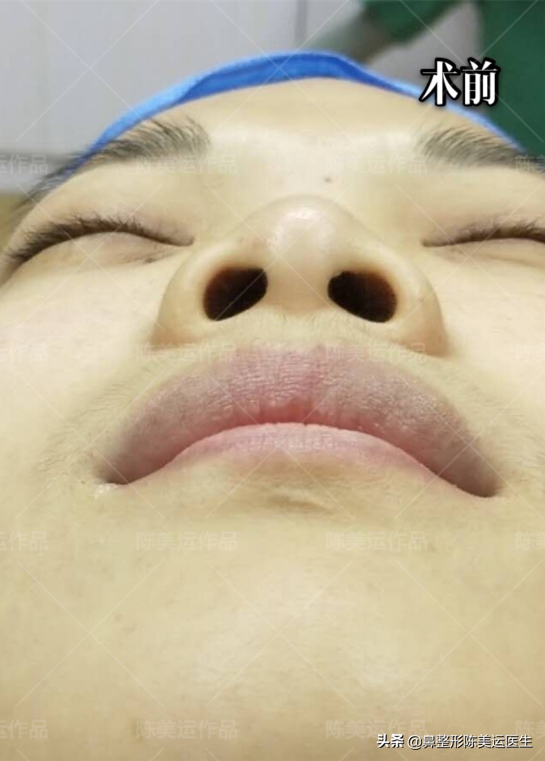 短塌鼻子可以做成直鼻吗,塌鼻子怎么能变成尖鼻子