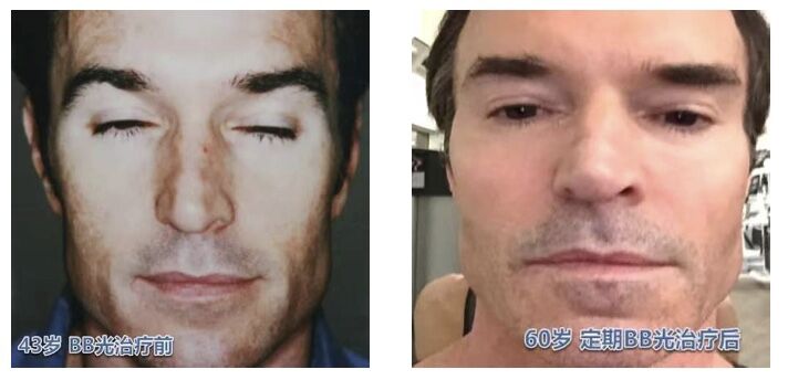 光子嫩肤基础护肤,基础护肤的光子嫩肤