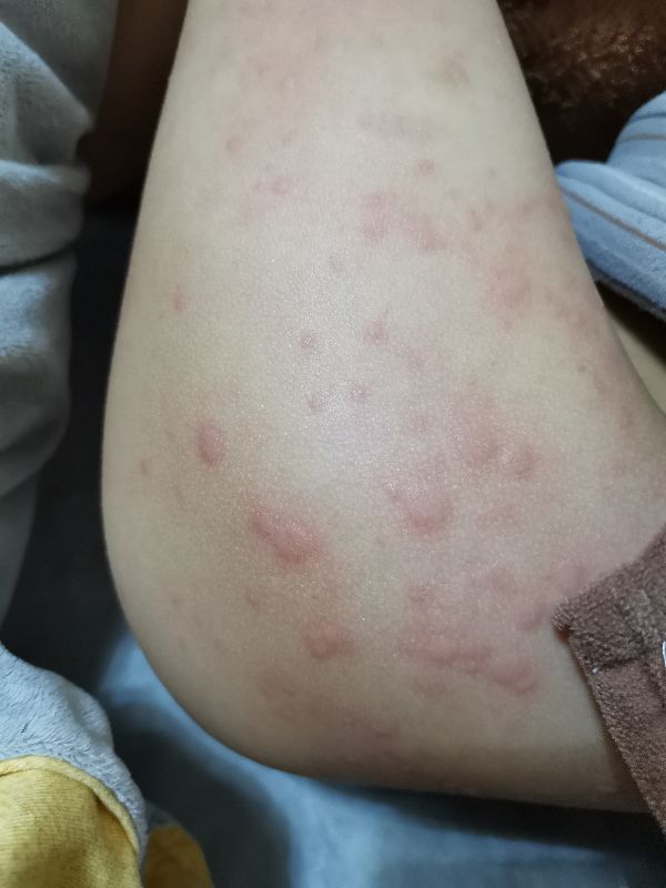 宝宝身上起好多疙瘩，跟蚊子咬的差不多，很痒，怎么办亲身经历