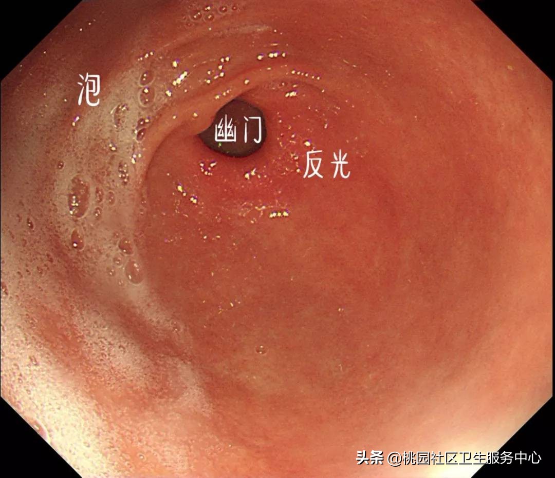 手把手教你：3分钟看懂胃镜报告