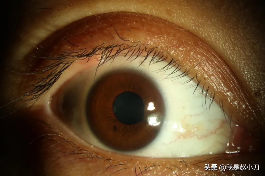 麦粒肿怎么治疗用什么眼药水治疗,麦粒肿可以用多久治愈