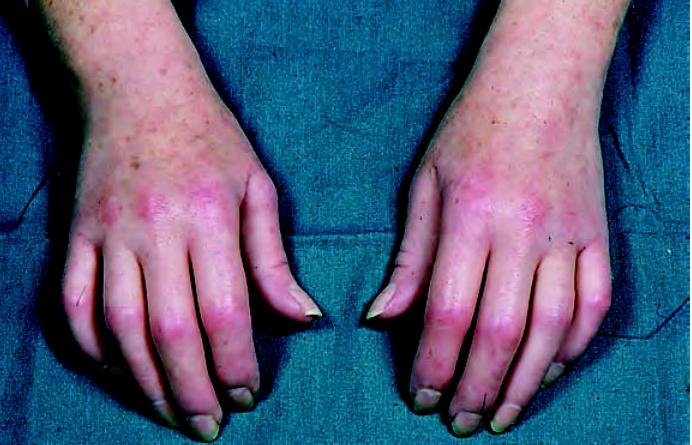 多发性硬化症和系统性硬皮病,系统性硬皮病有什么症状