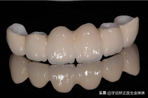 做的烤瓷牙根部发黑了怎么回事,烤瓷牙为什么牙根会变黑