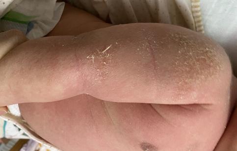 新冠出现湿疹怎么办,满月的宝宝突然长湿疹了怎么办