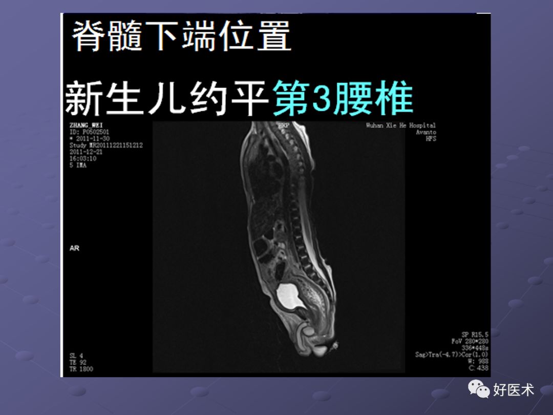 脊柱mri有哪些特点,乳腺疾病的mri诊断及鉴别